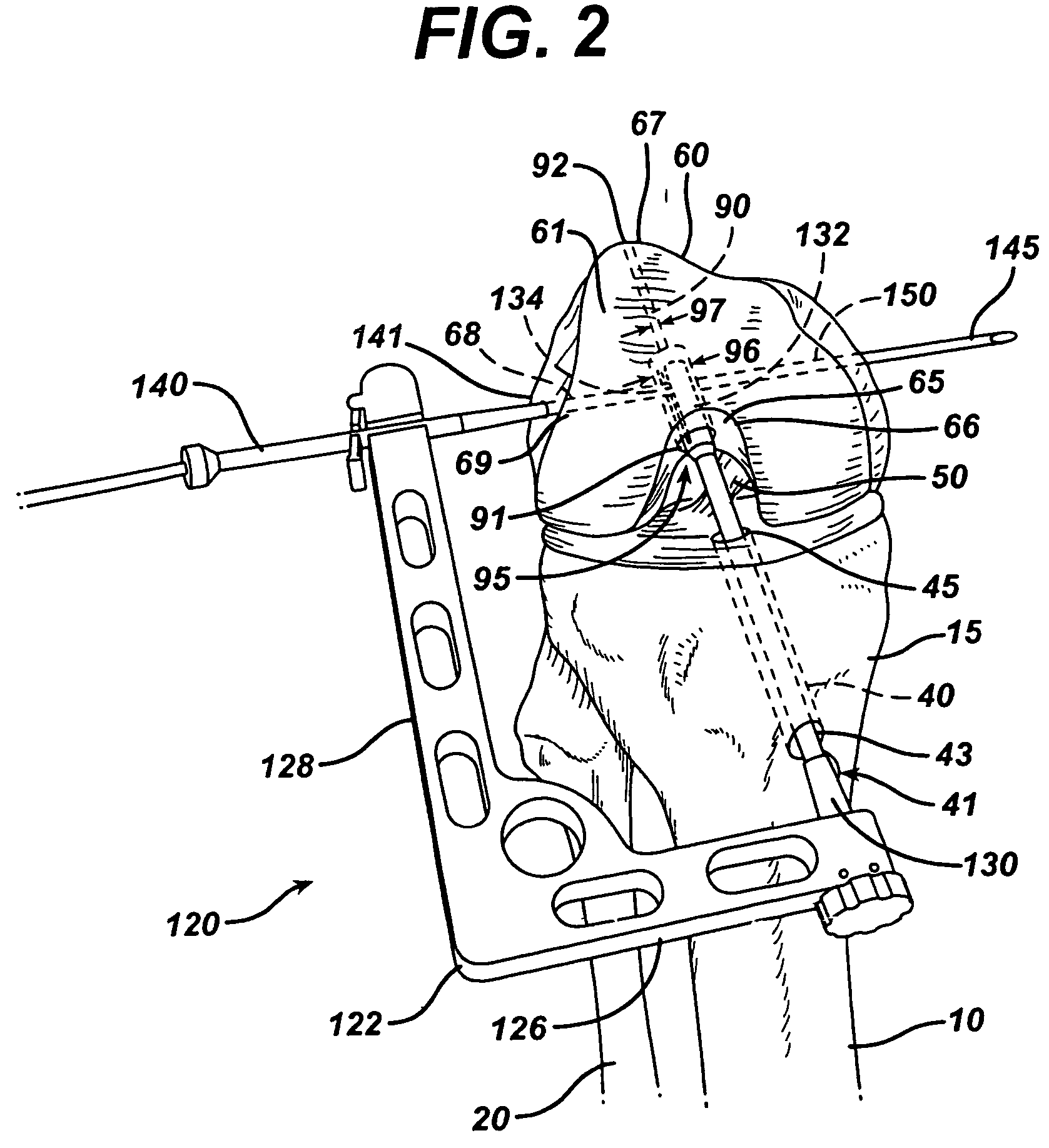 Method of replacing an anterior cruciate ligament in the knee