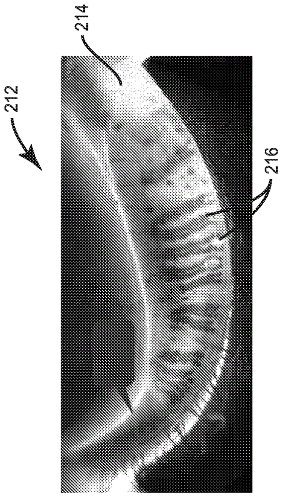 Eyelid illumination systems and methods for imaging meibomian glands for meibomian gland analysis