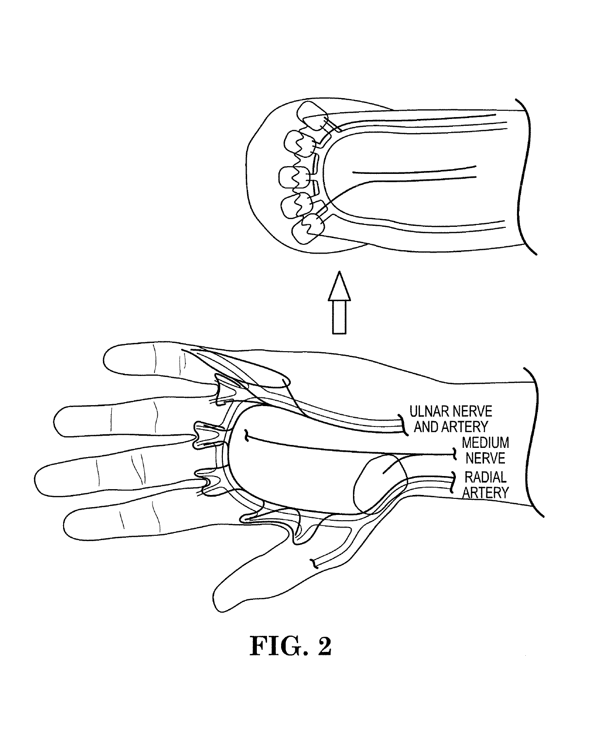 Myoelectric prosthesis and method