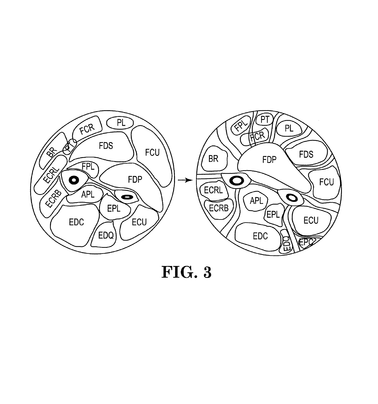 Myoelectric prosthesis and method