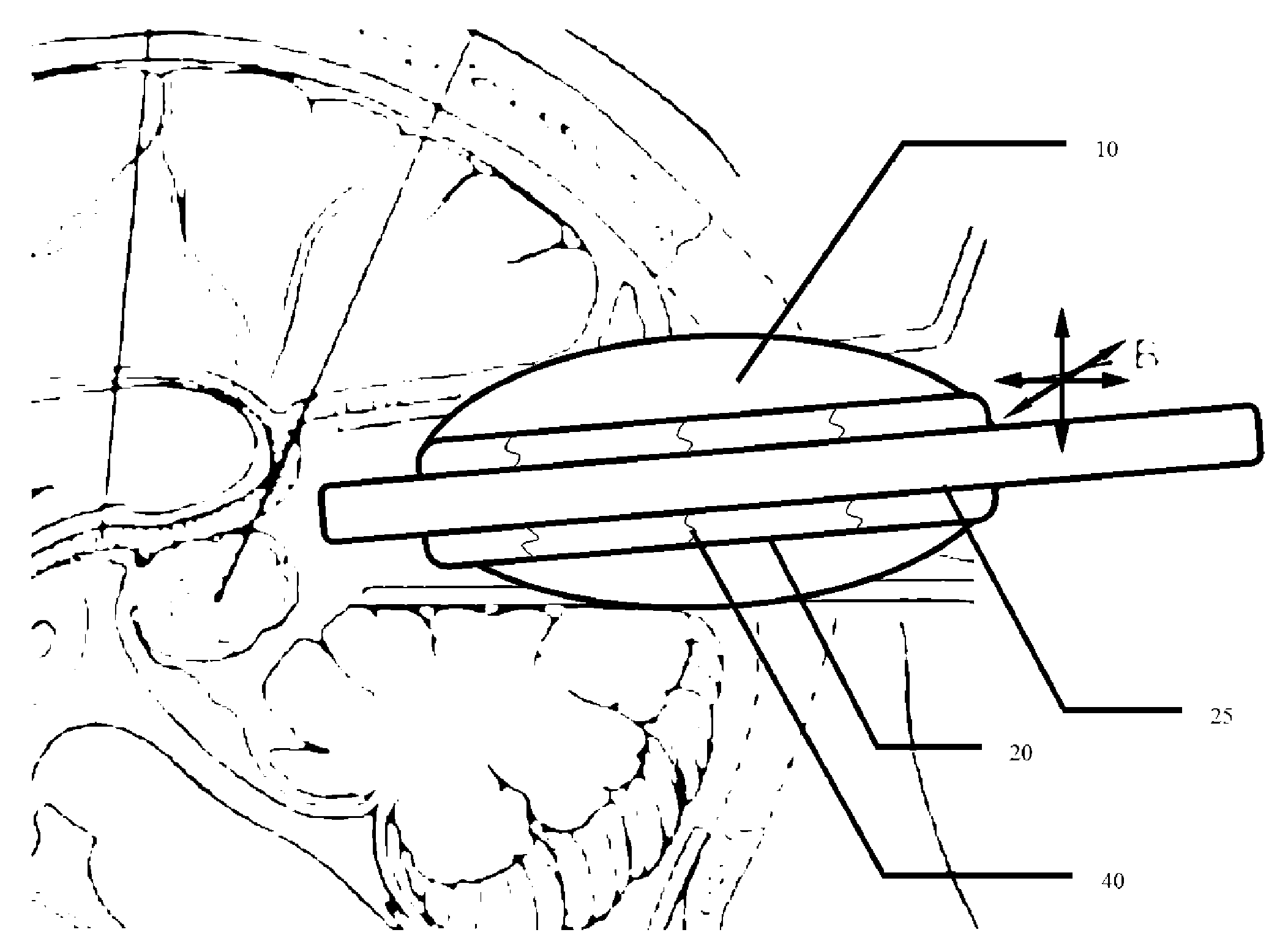 Endoscopic Sheath Having a Biomimetic Retractor