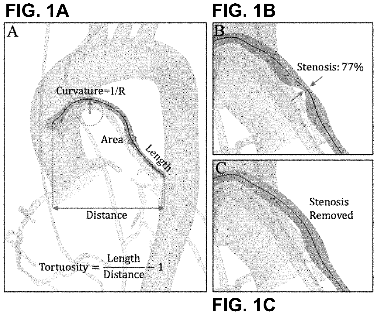 Hemodynamic and Morphological predictors of Vascular Graft Failure