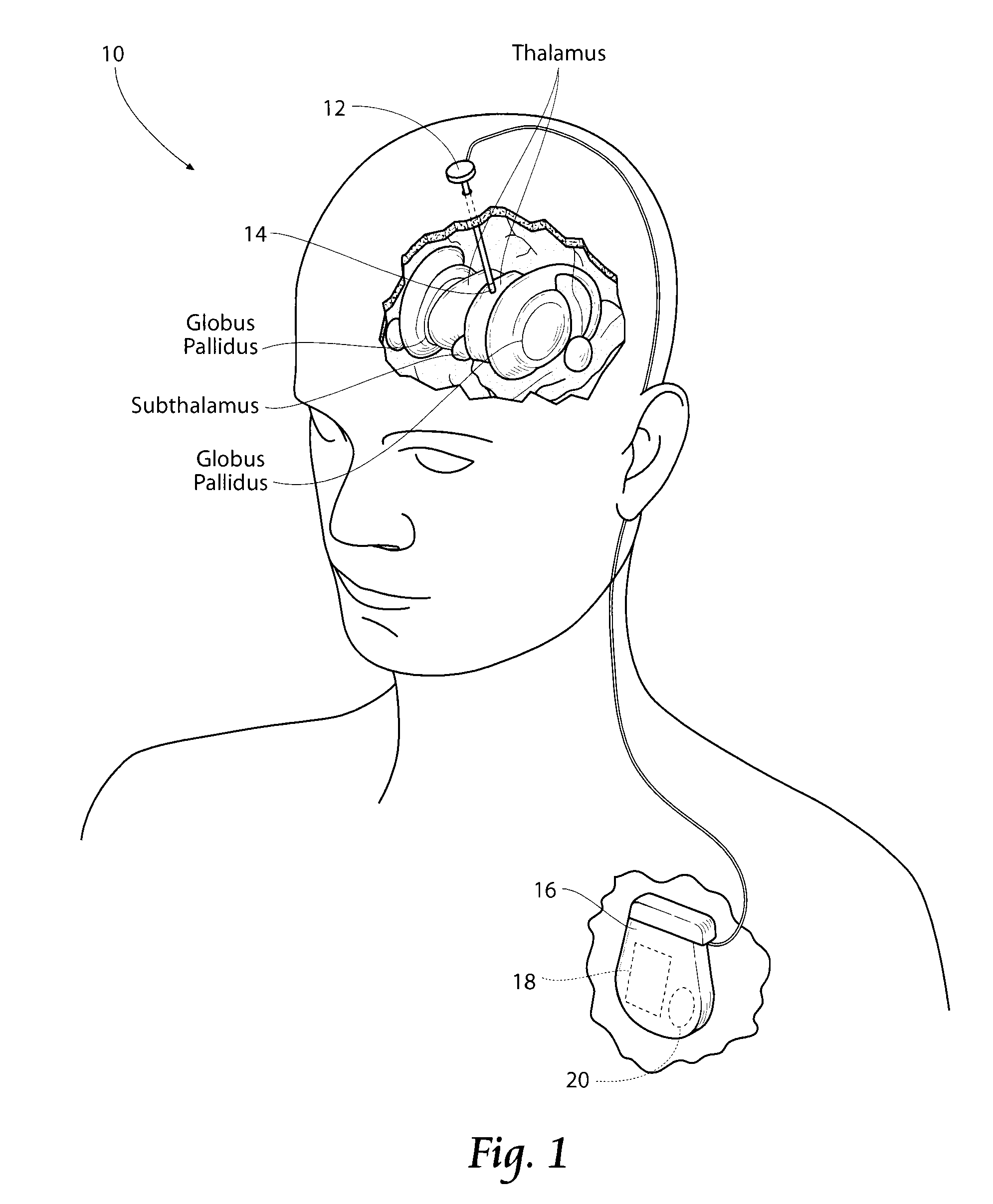 Non-regular electrical stimulation patterns for treating neurological disorders