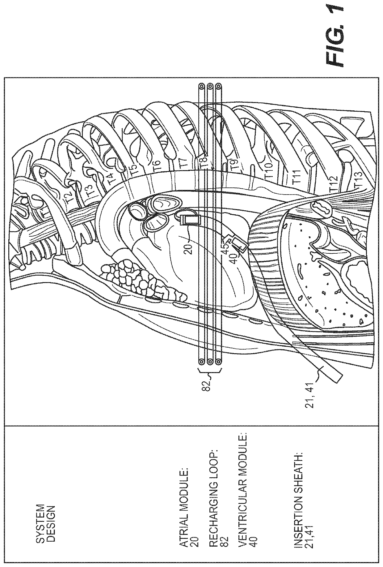 Epicardial lead design