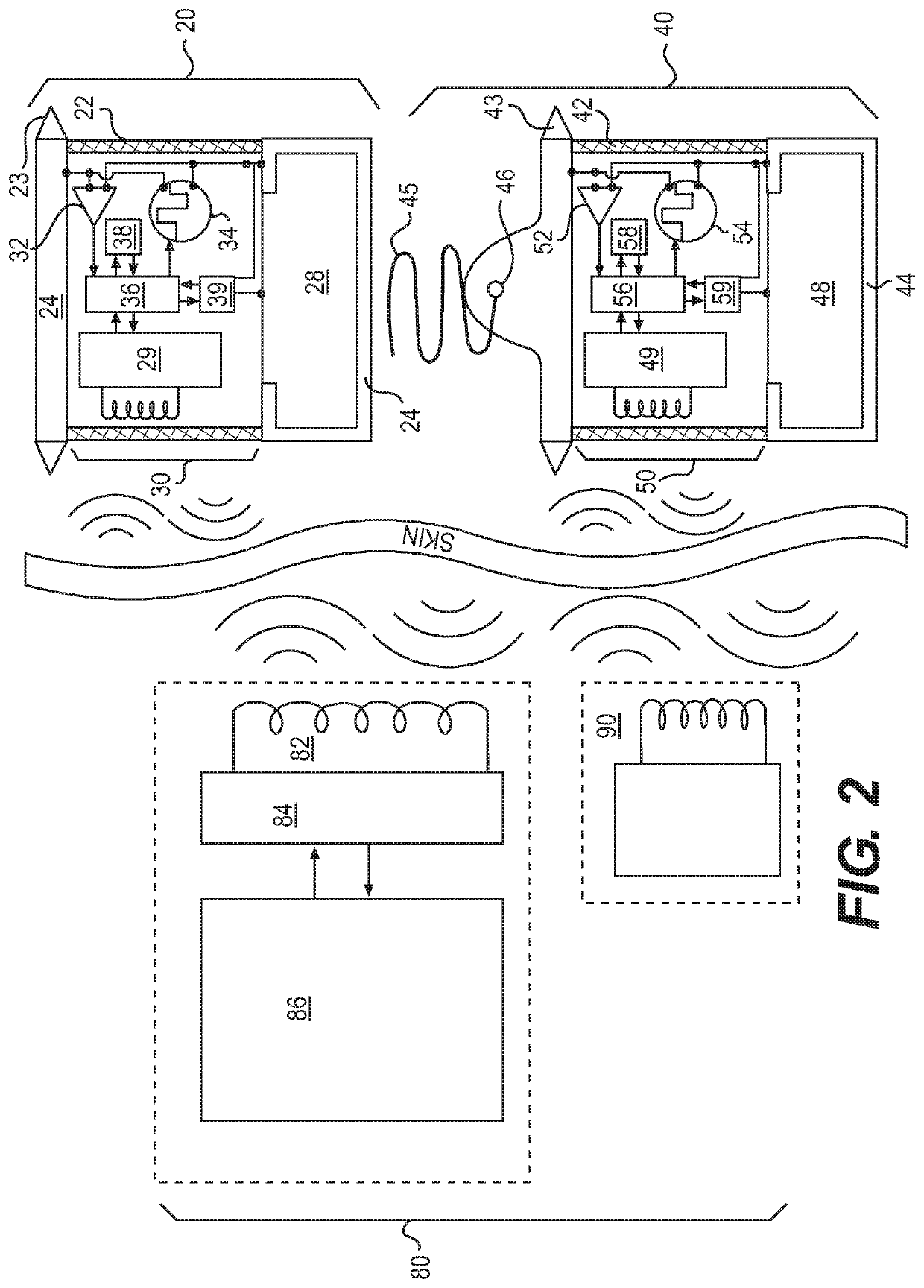 Epicardial lead design