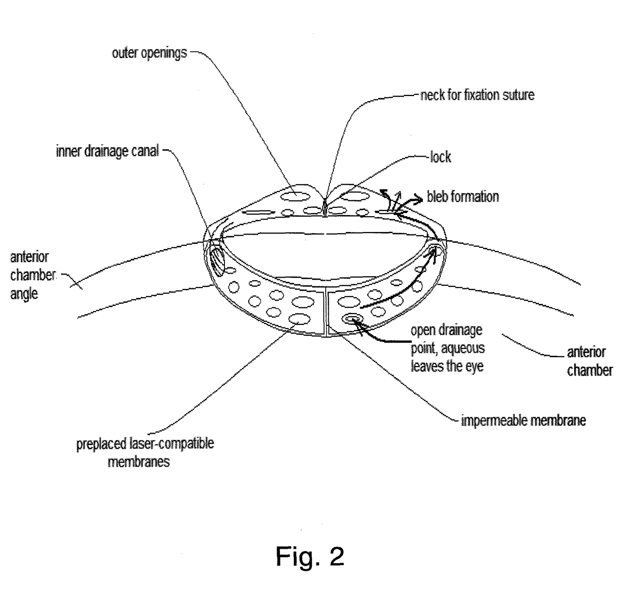 Toroidal glaucoma drainage device