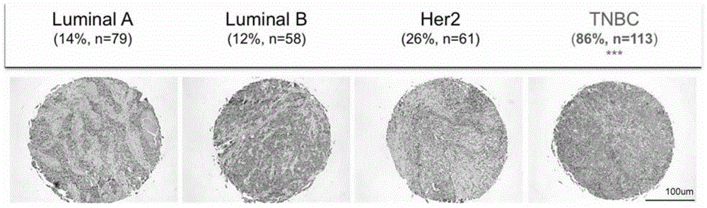 Triple-negative breast cancer marker and applications of triple-negative breast cancer marker in diagnosis and therapy