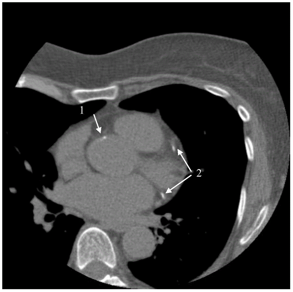 A fully automatic calculation method of coronary artery calcification score in CT images