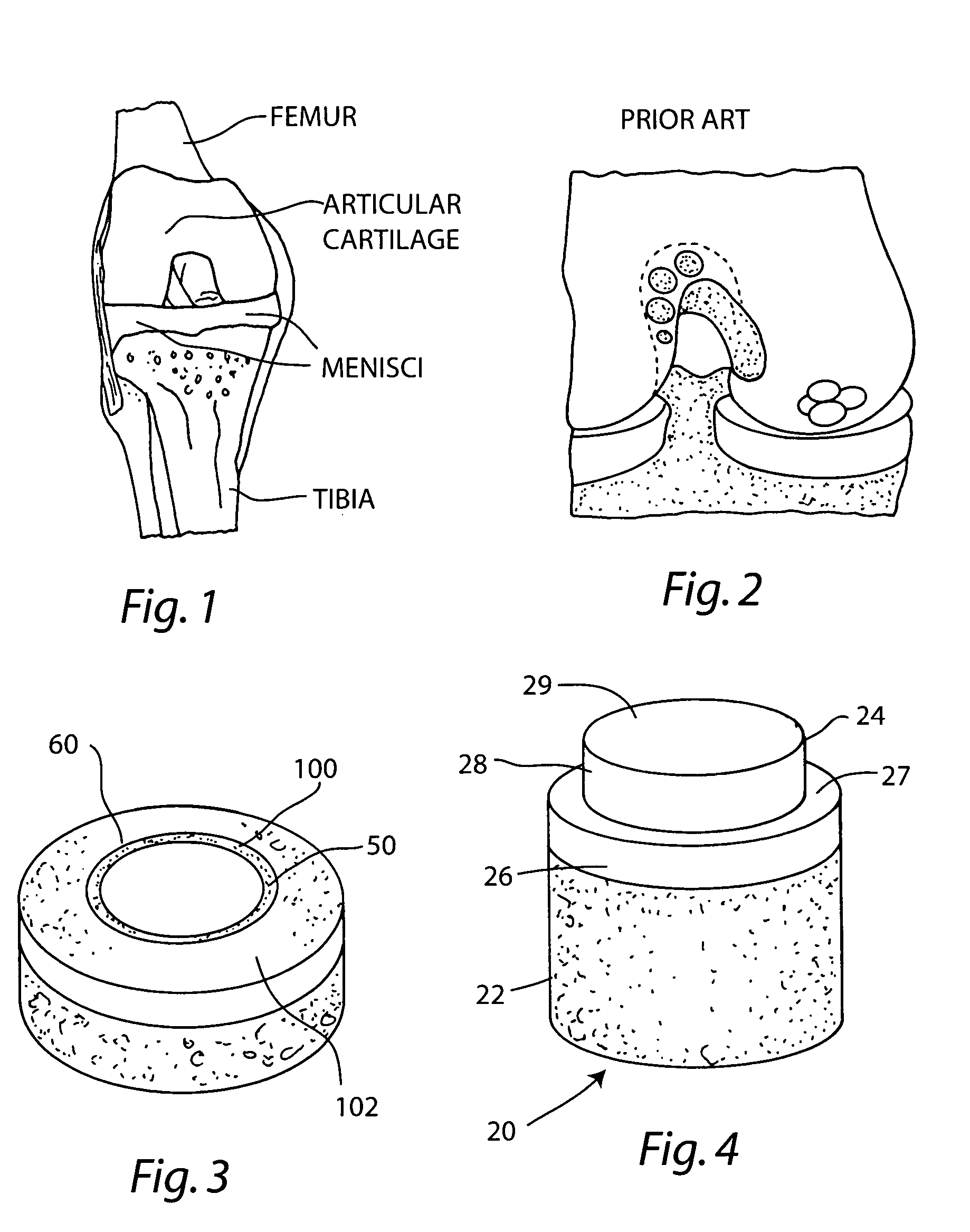 Cartilage allograft plug