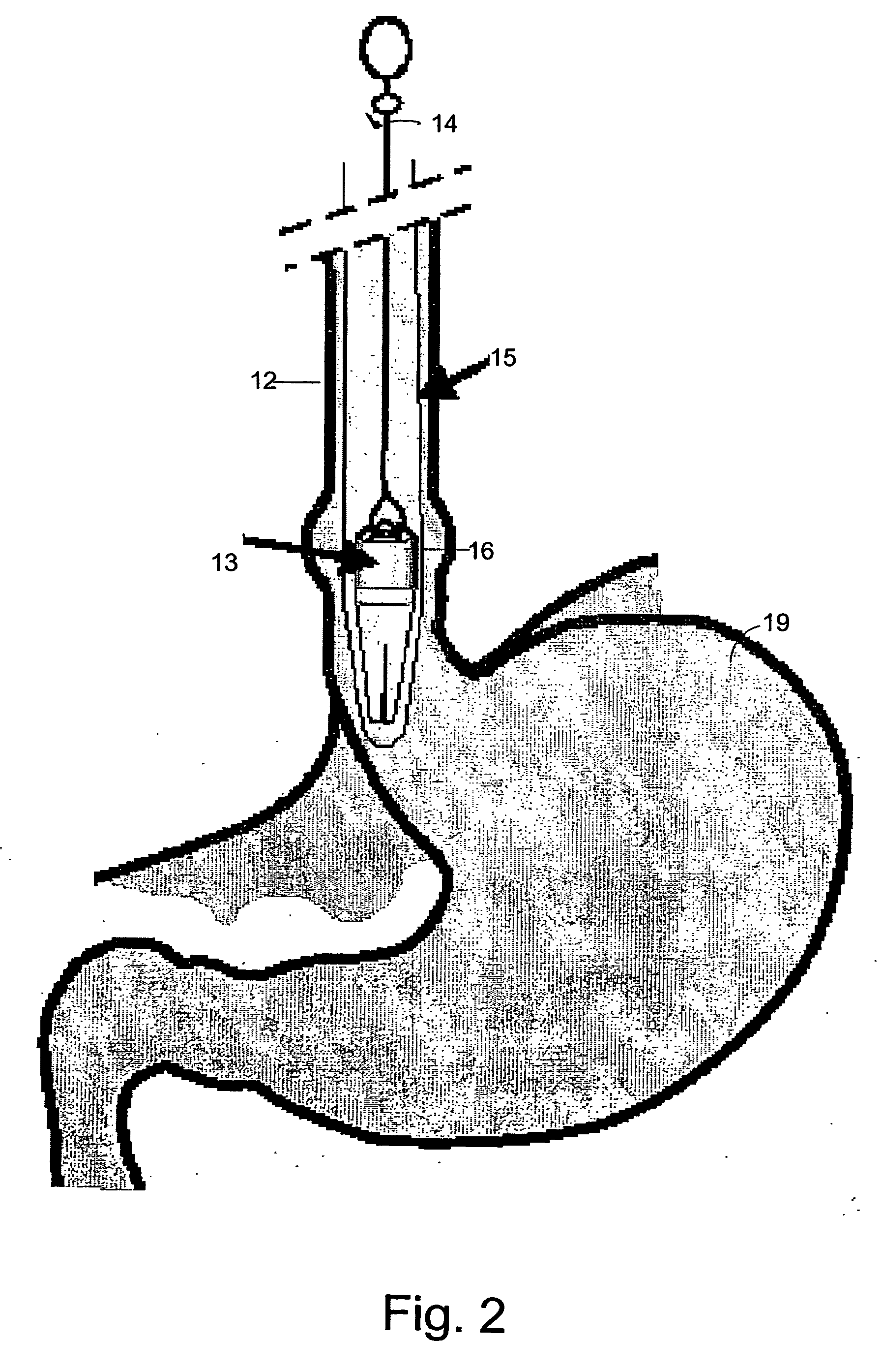 Gastrointestinal anti-reflux prosthesis apparatus and method