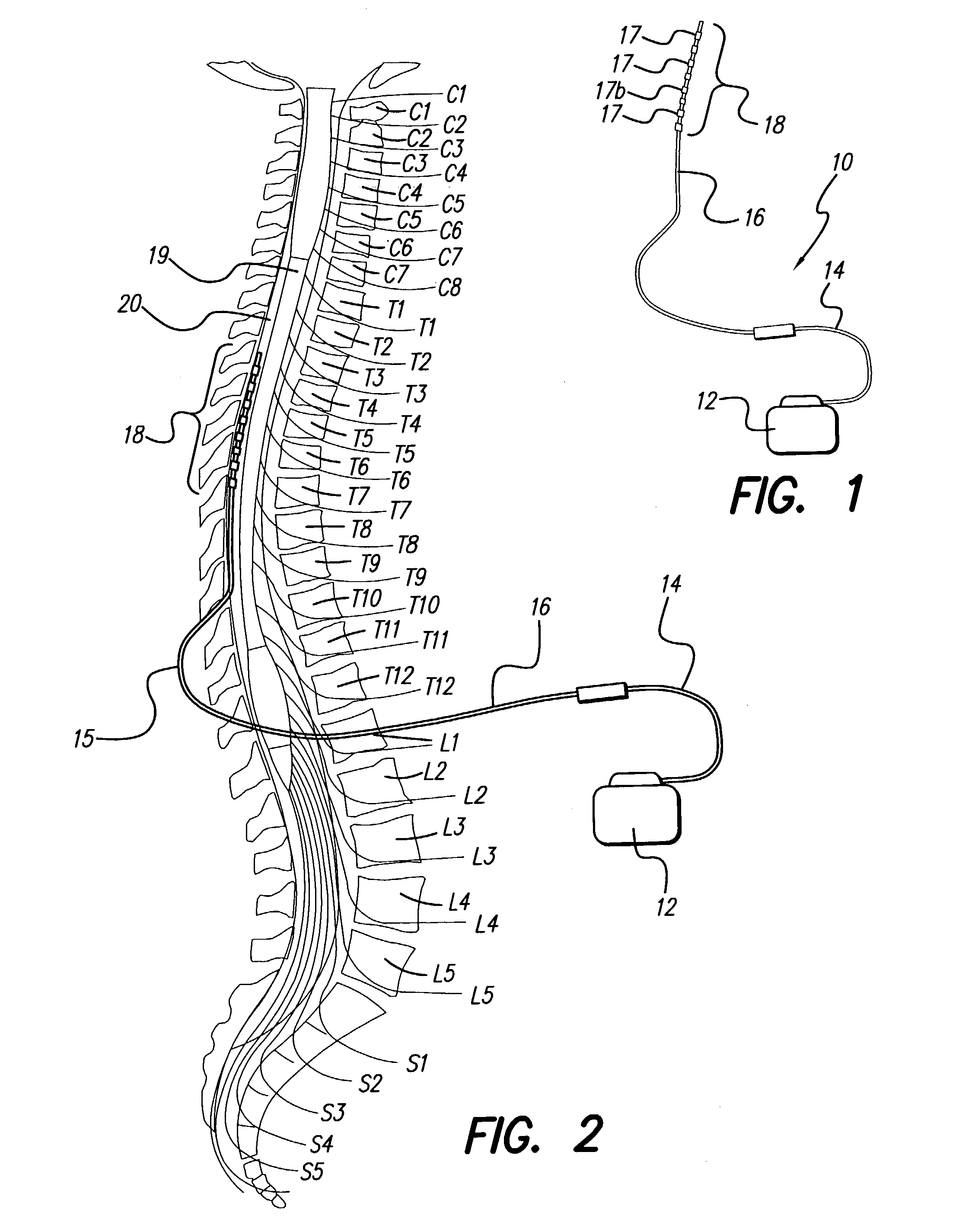 Neural stimulation system providing auto adjustment of stimulus output as a function of sensed pressure changes