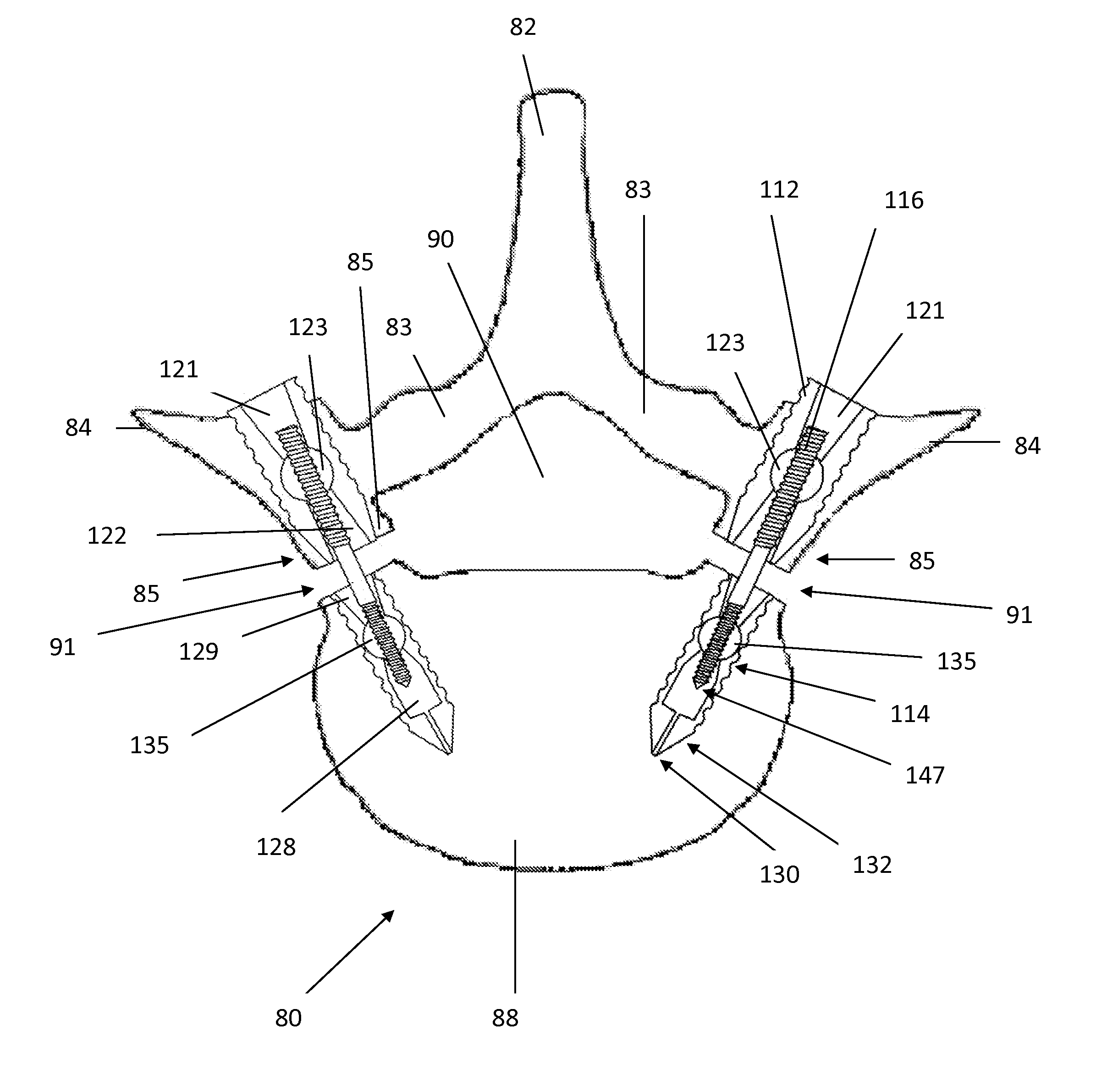 Surgical implants for percutaneous lengthening of spinal pedicles to correct spinal stenosis