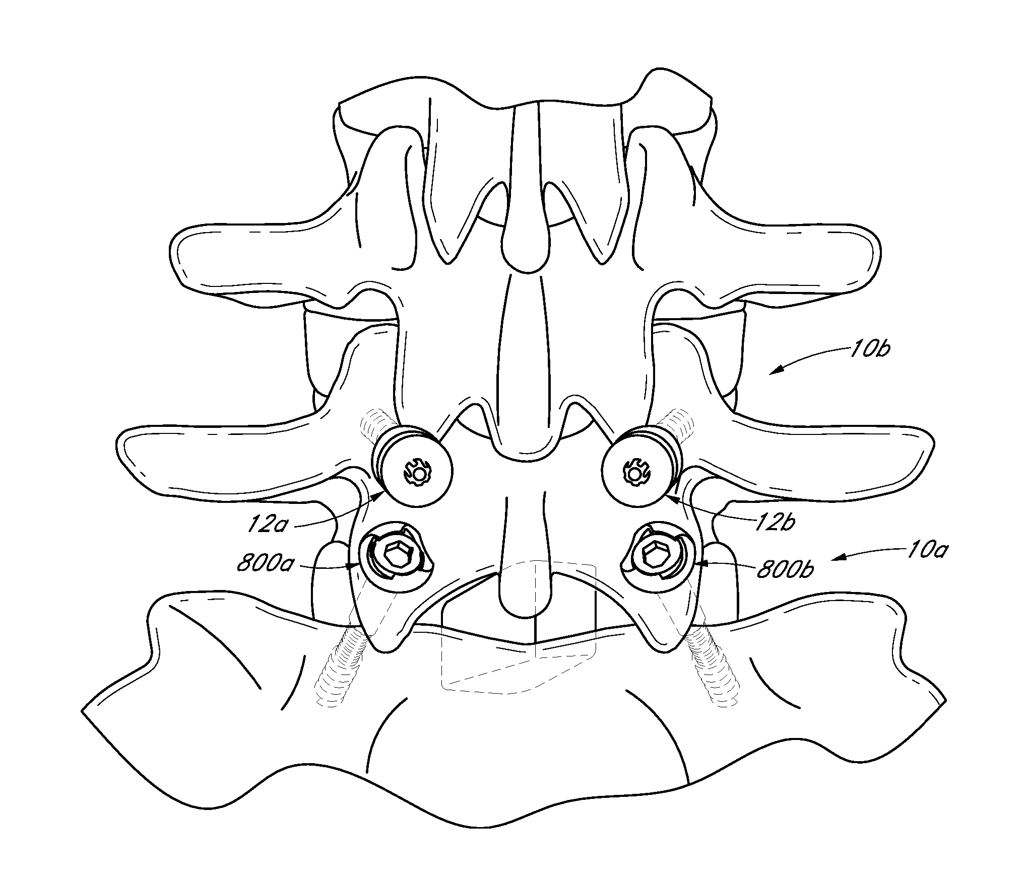 Method and apparatus for spinal stabilization