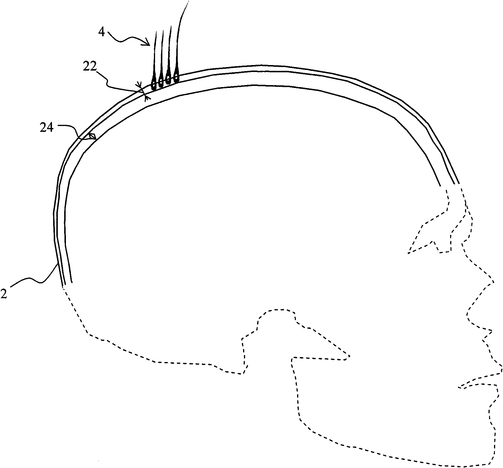 Lifeless hair transplant method