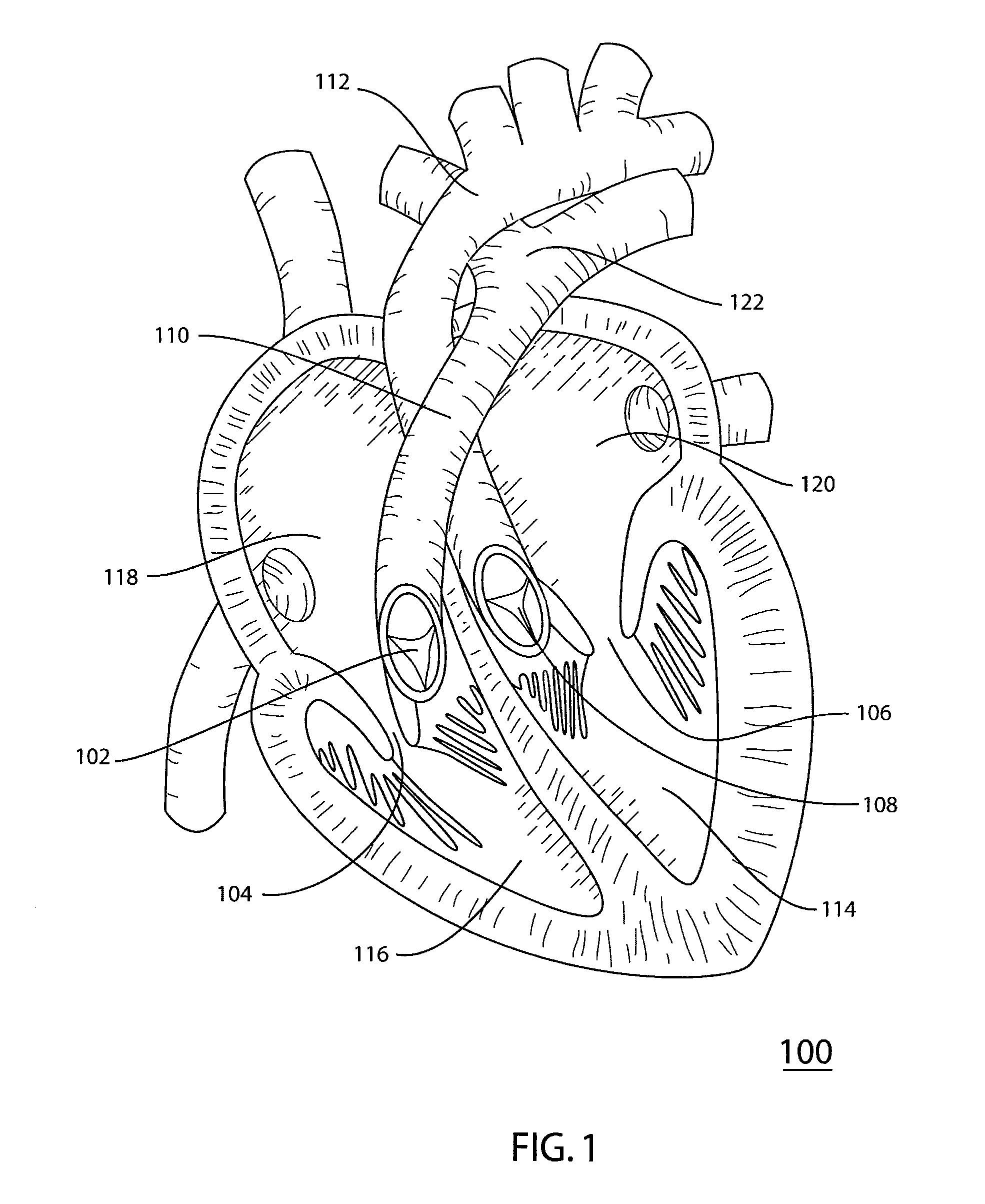 Reinforced surgical conduit for implantation of a stented valve therein