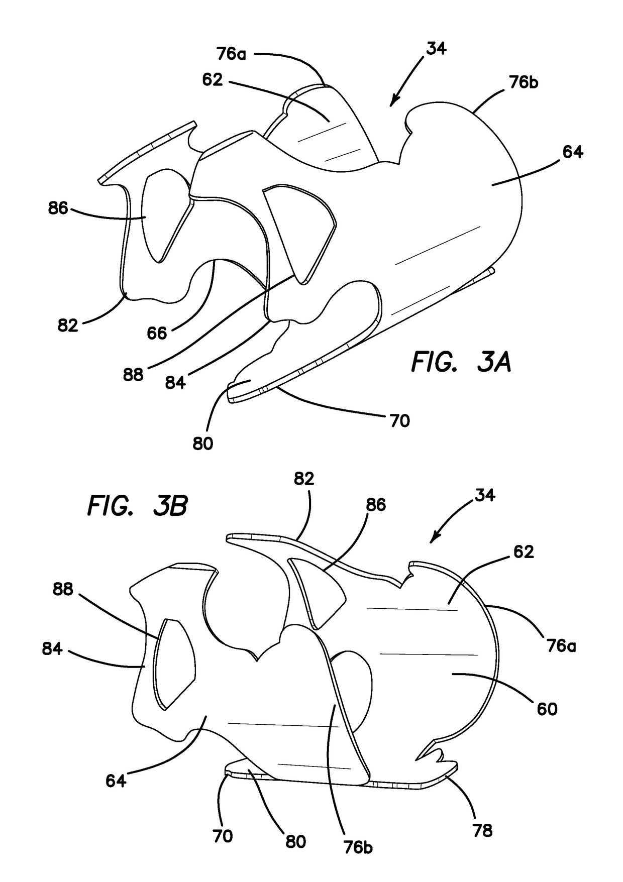 Hysterectomy model