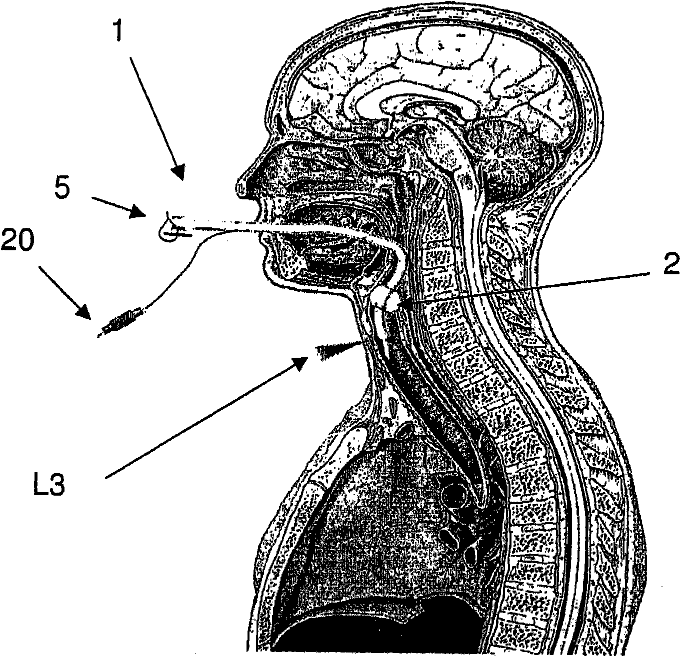 Endotracheal tube