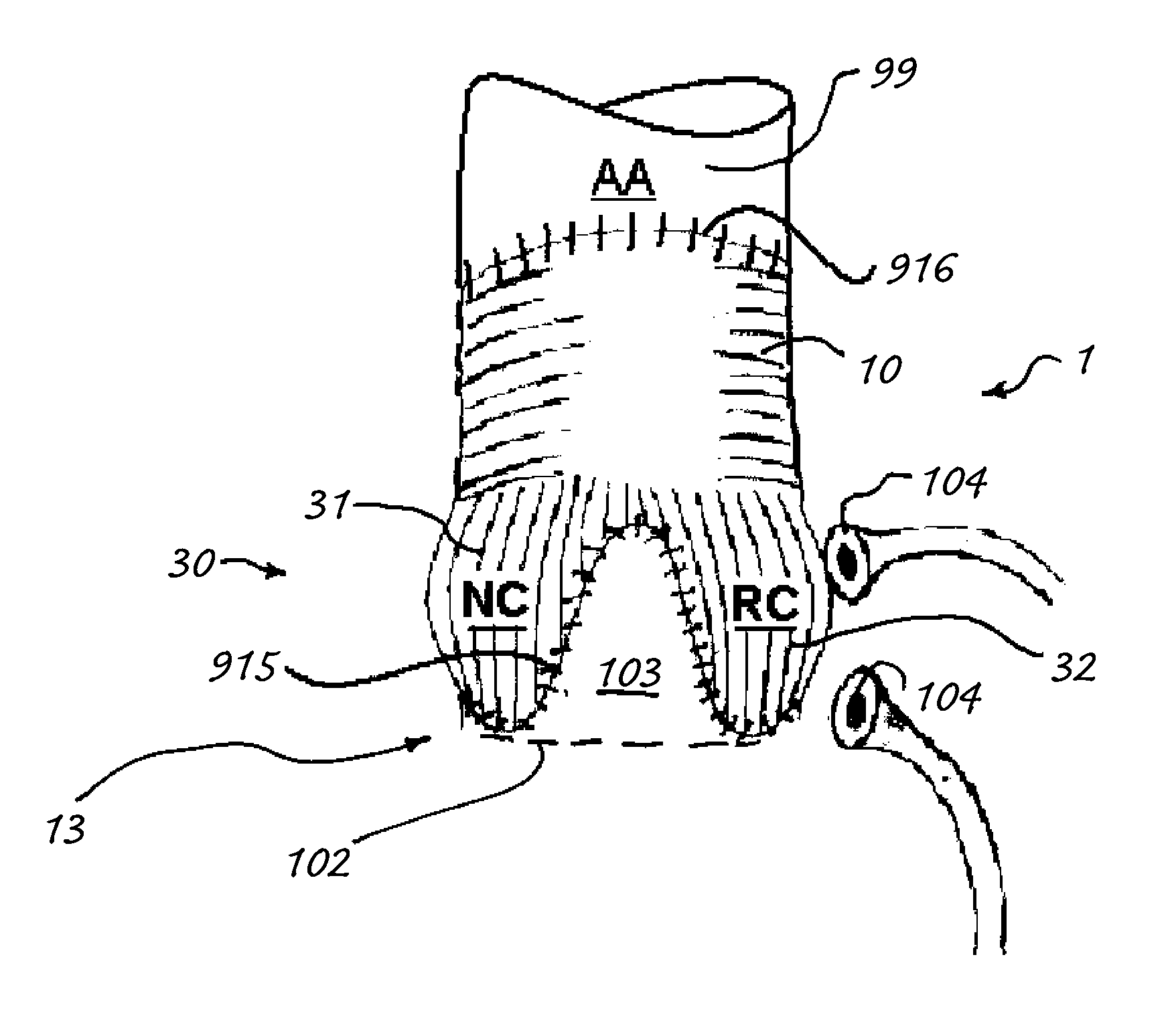 Aortic conduit configured with terminal ends having neosinuses of valsalva