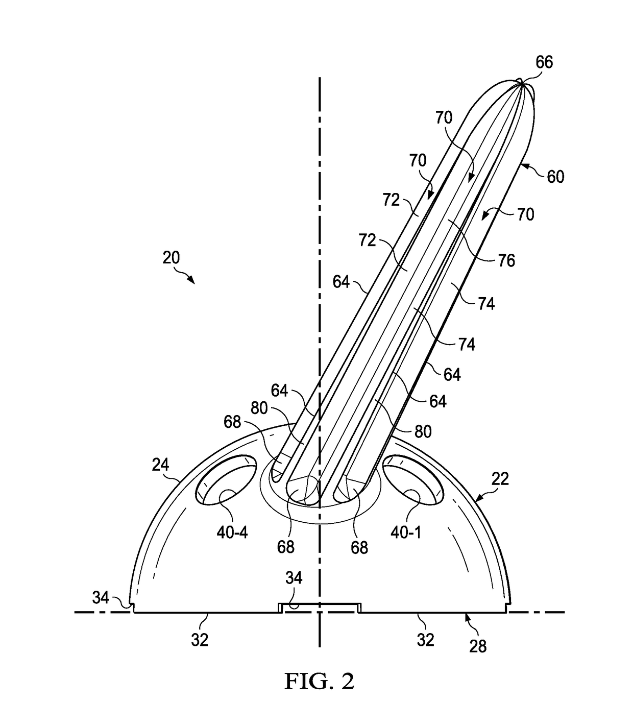 Acetabular surgical implant for segmental pelvic defect and methods of use and manufacture