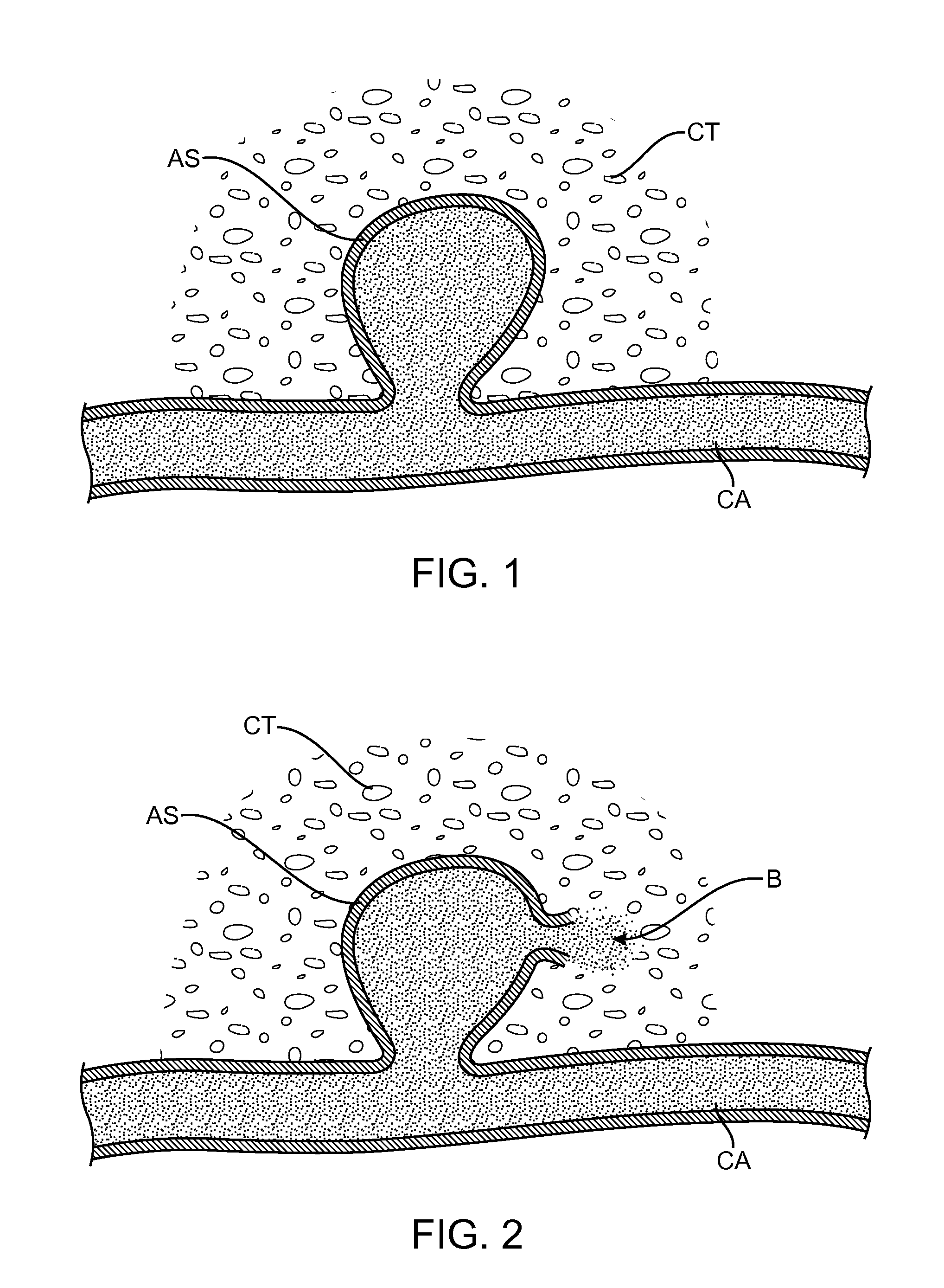 System and method for treatment of hemorrhagic stroke