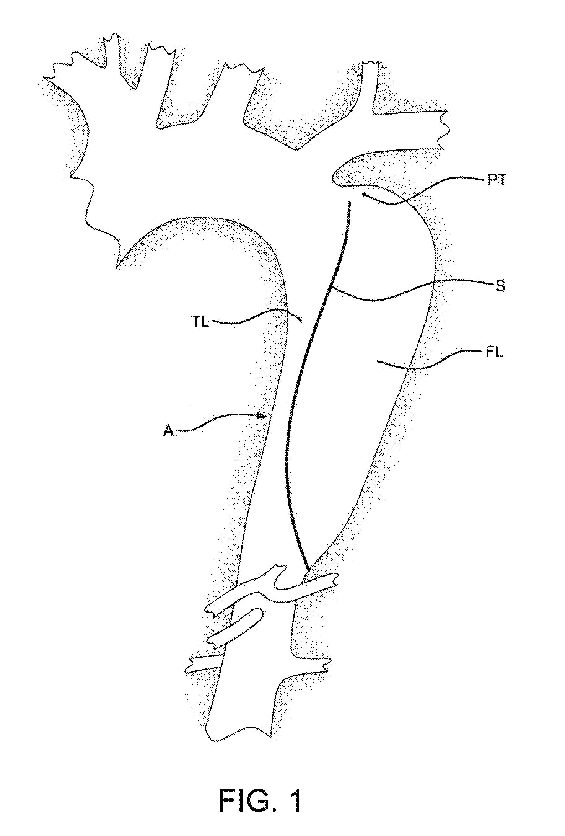 Aortic dissection septal cutting tool