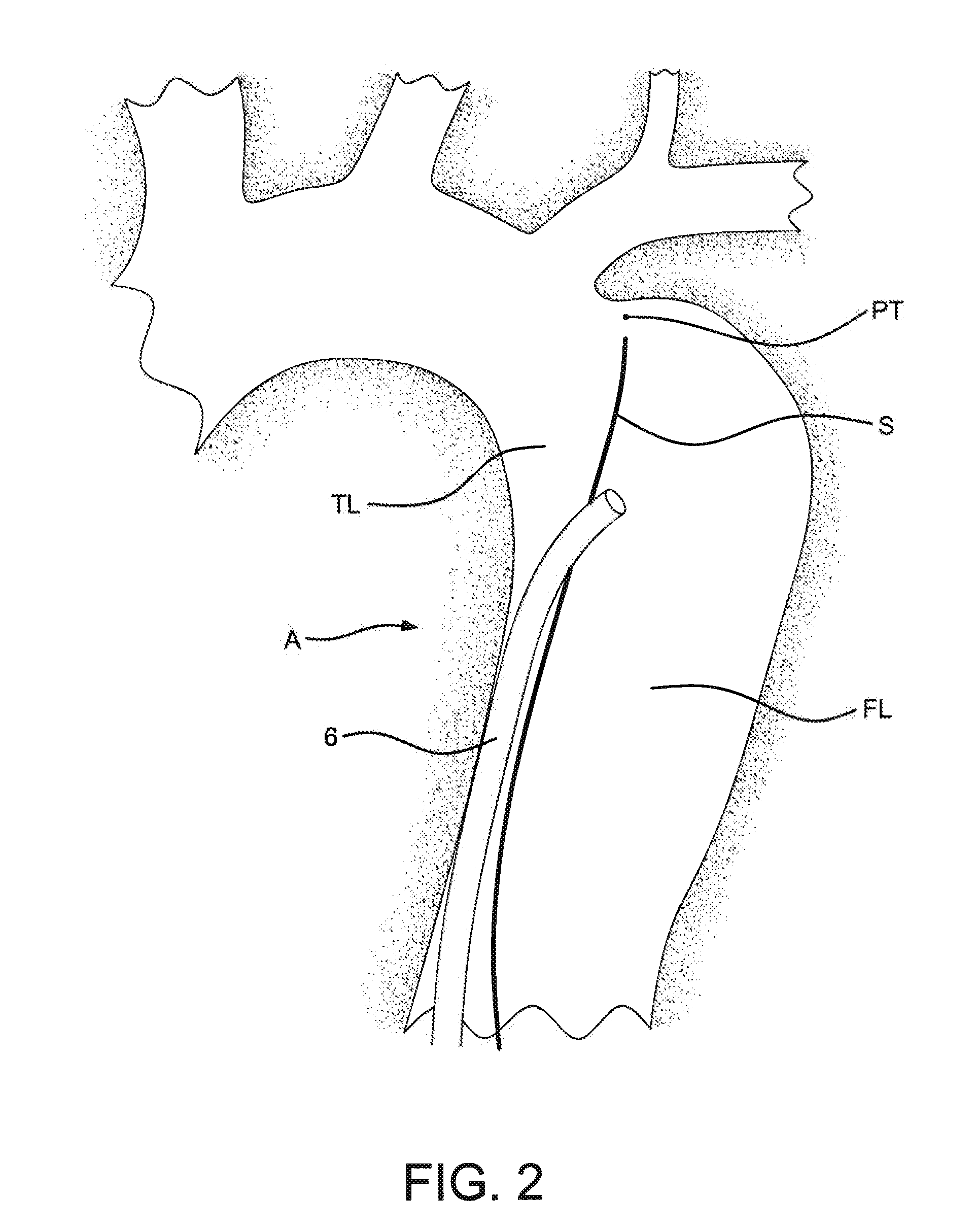 Aortic dissection septal cutting tool