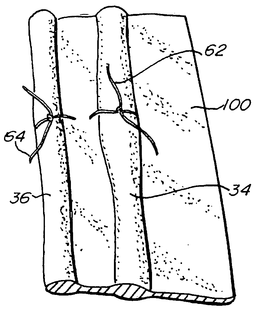 Uterine Artery Ligation Devices and Methods