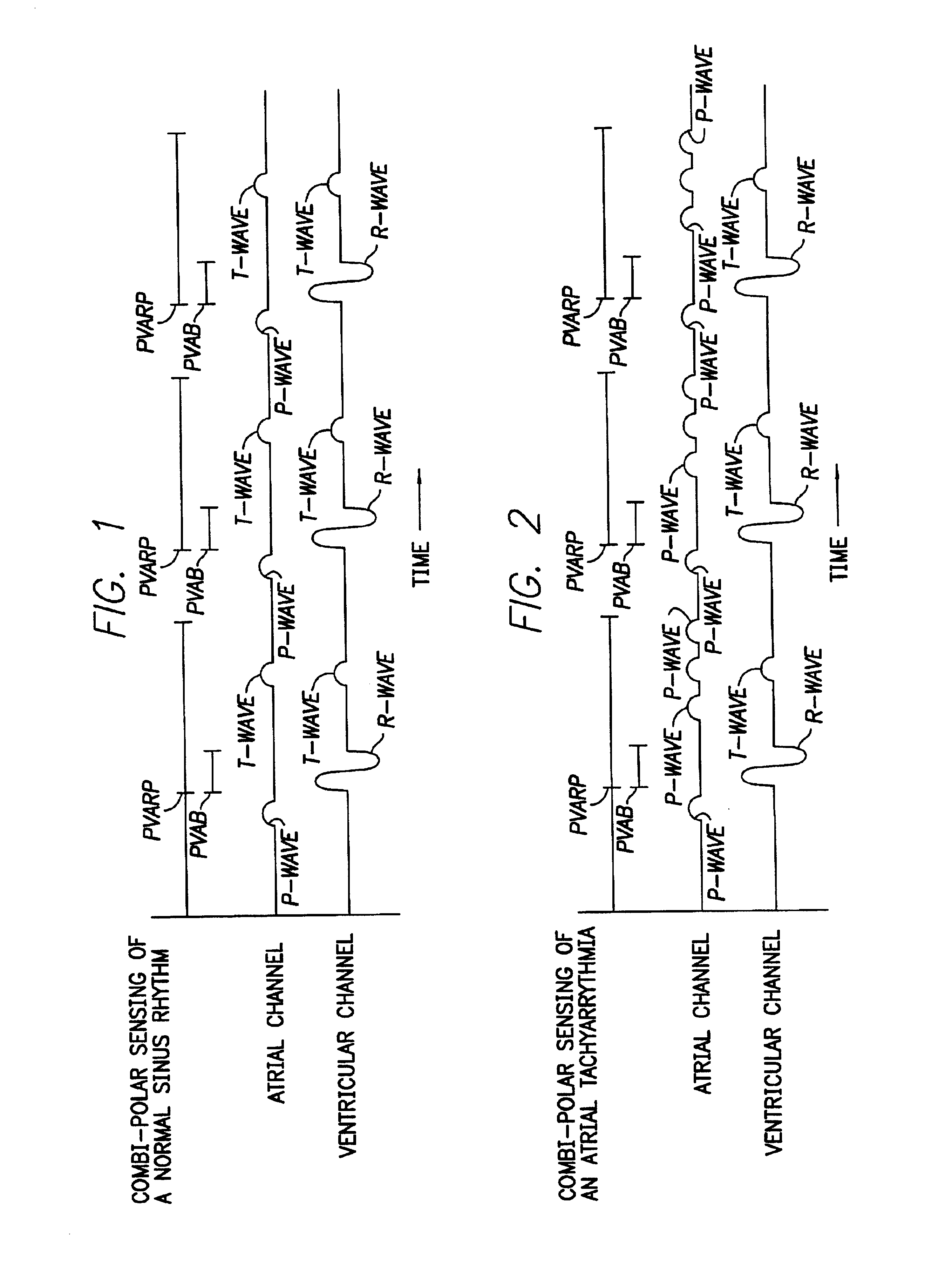 Method and apparatus for blanking T-waves from combipolar atrial cardiac signals based on expected T-wave locations