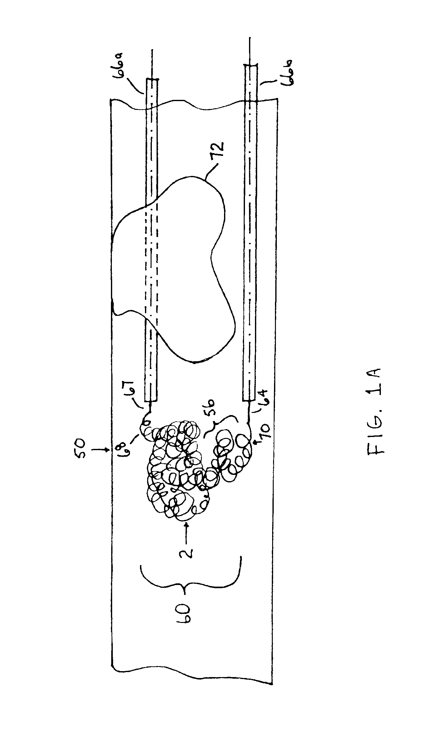 Thrombus removal system and process