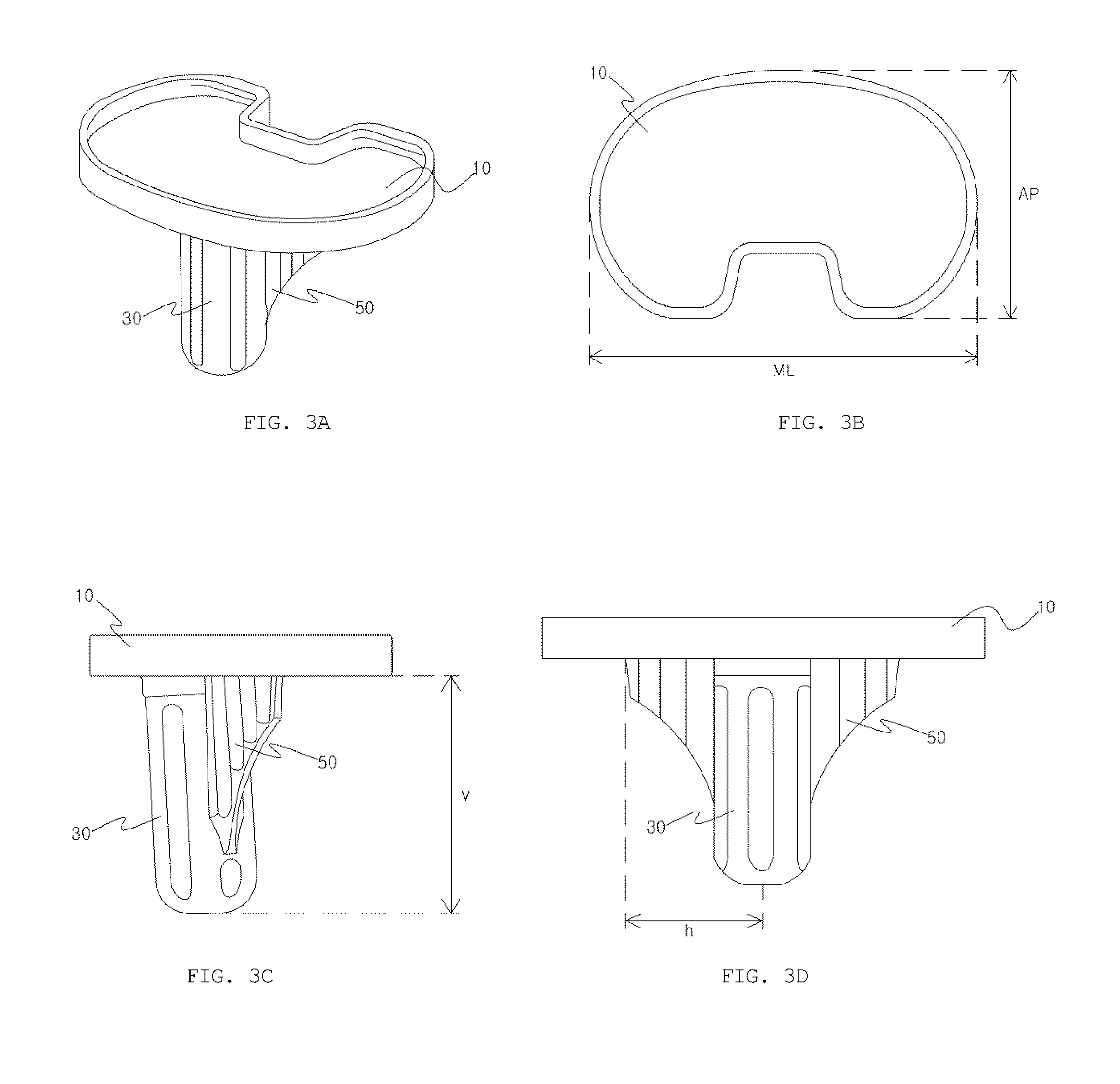 Method of Manufacturing Patient-Customized Tibial Element