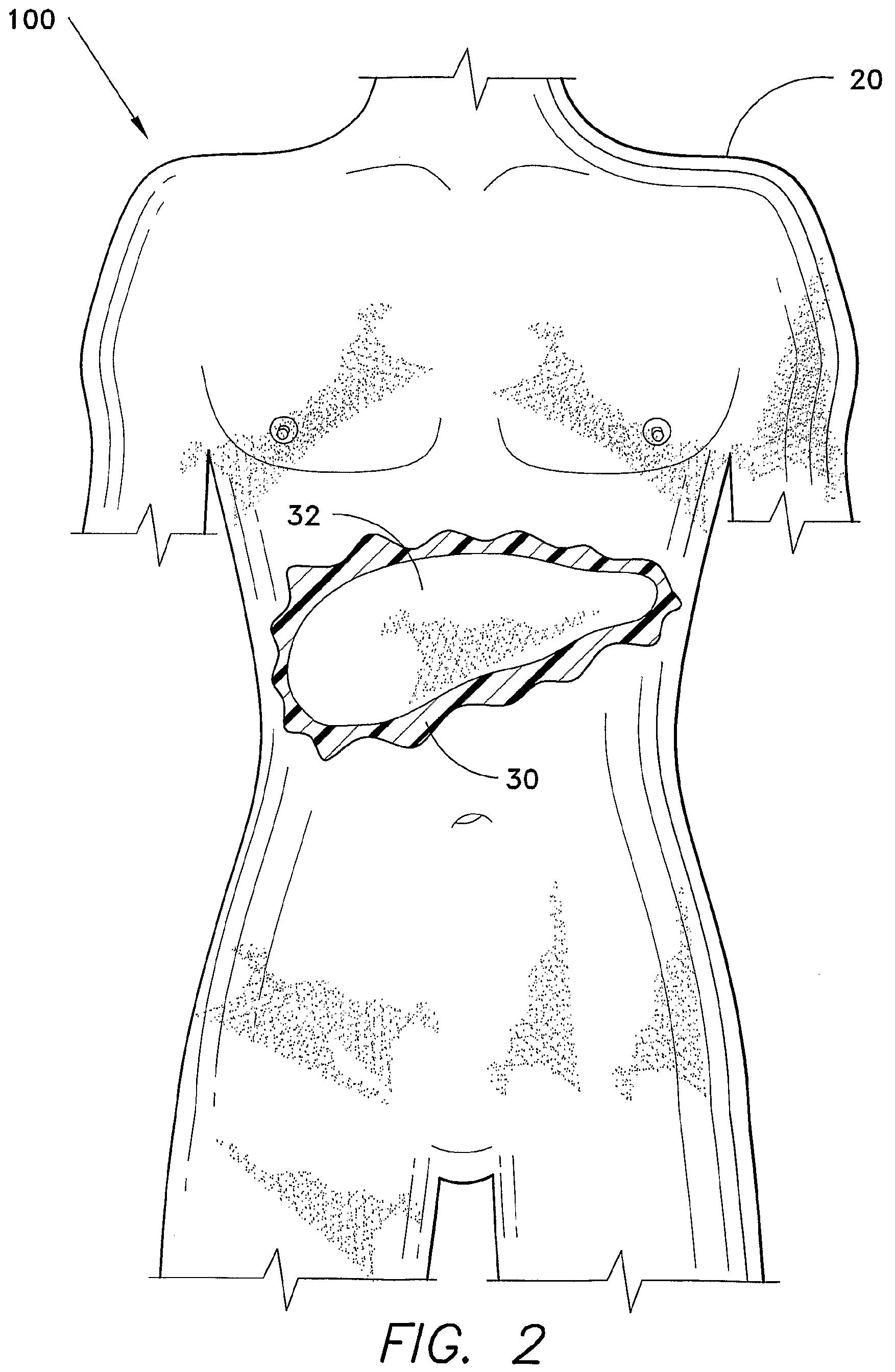 Ultrasound training mannequin