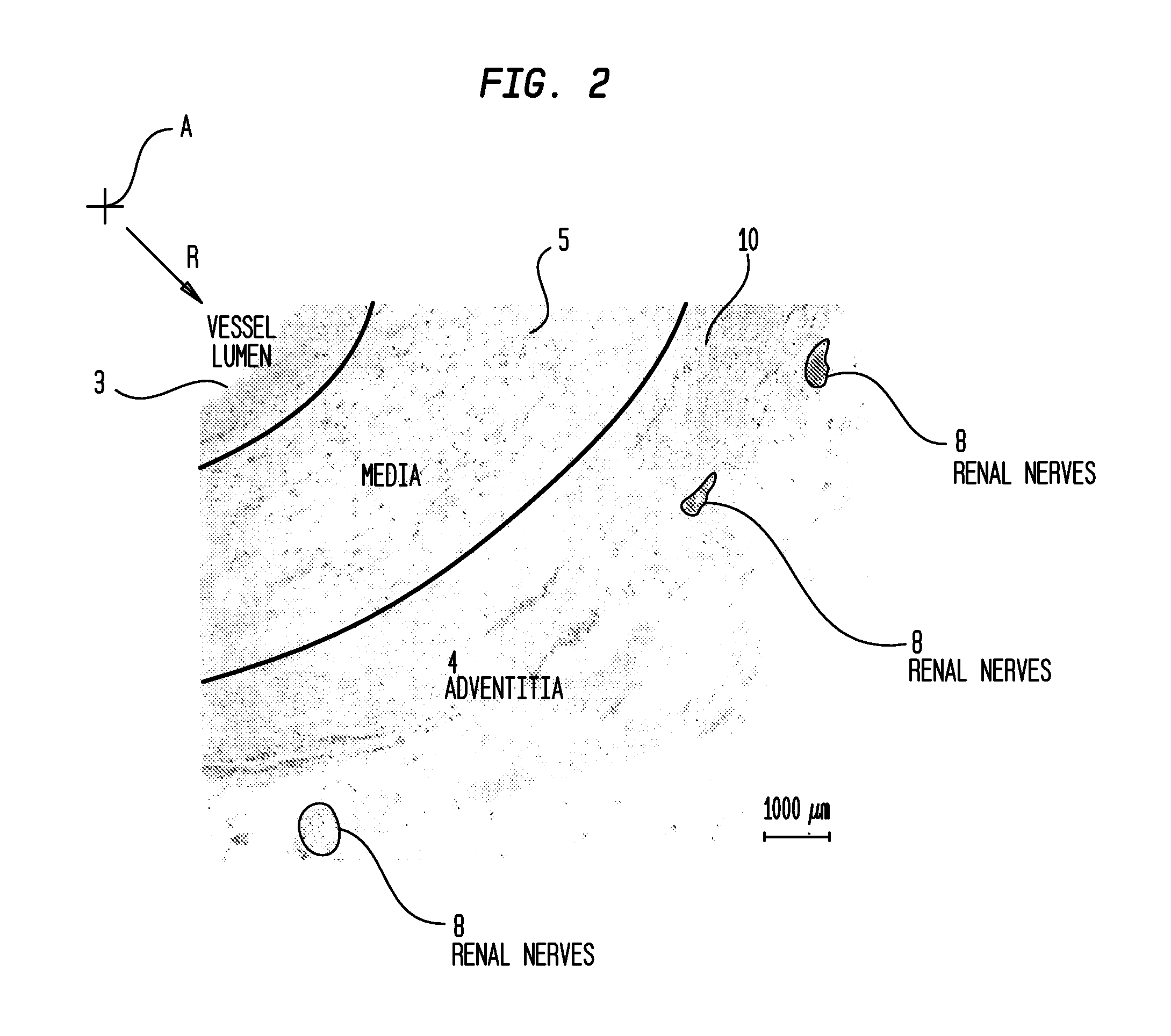 Method and Apparatus for Treatment of Hypertension Through Percutaneous Ultrasound Renal Denervation