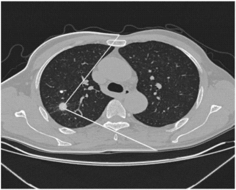 Optimal lung puncture operation path planning method and lung puncture operation navigation system