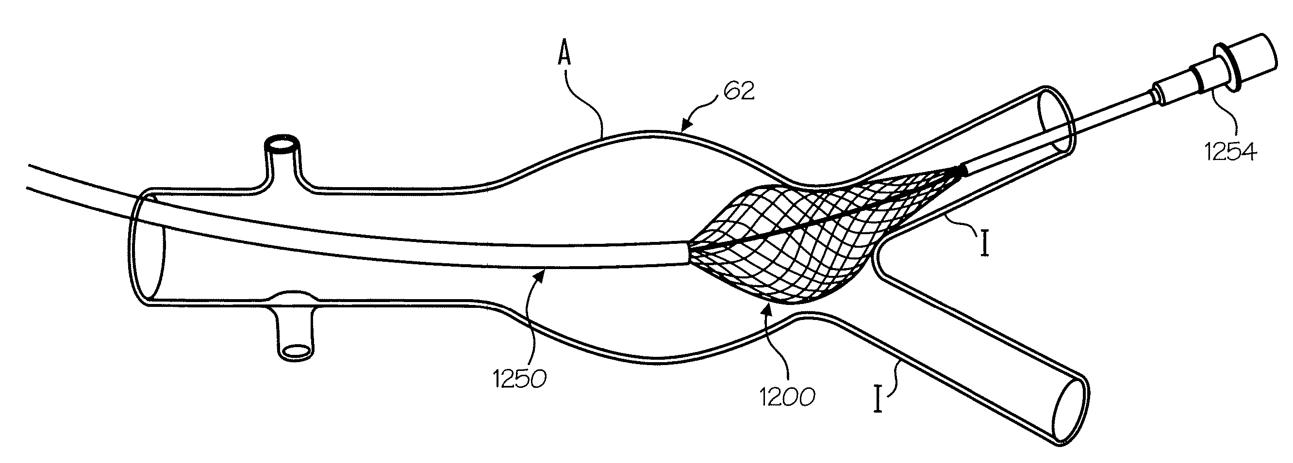 Non-occluding dilation device