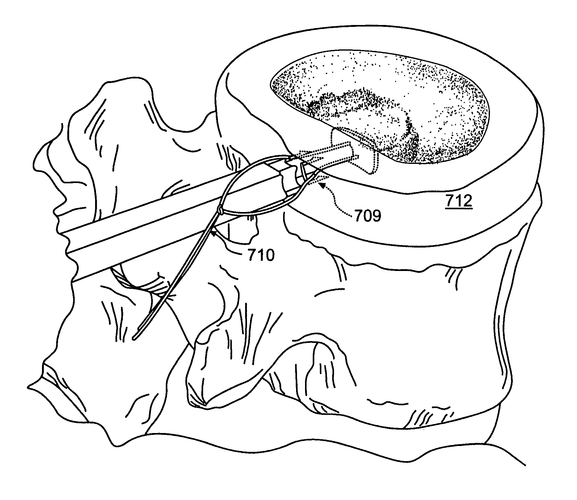 Method and apparatus for enhanced delivery of treatment device to the intervertebral disc annulus