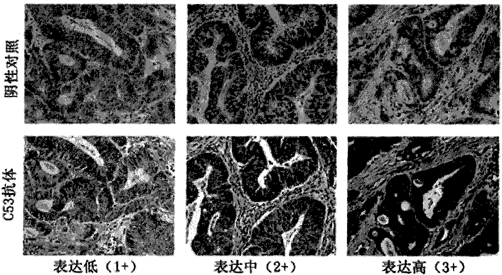 Method and reagent kit for forecasting outbreak age of carcinoma of colon