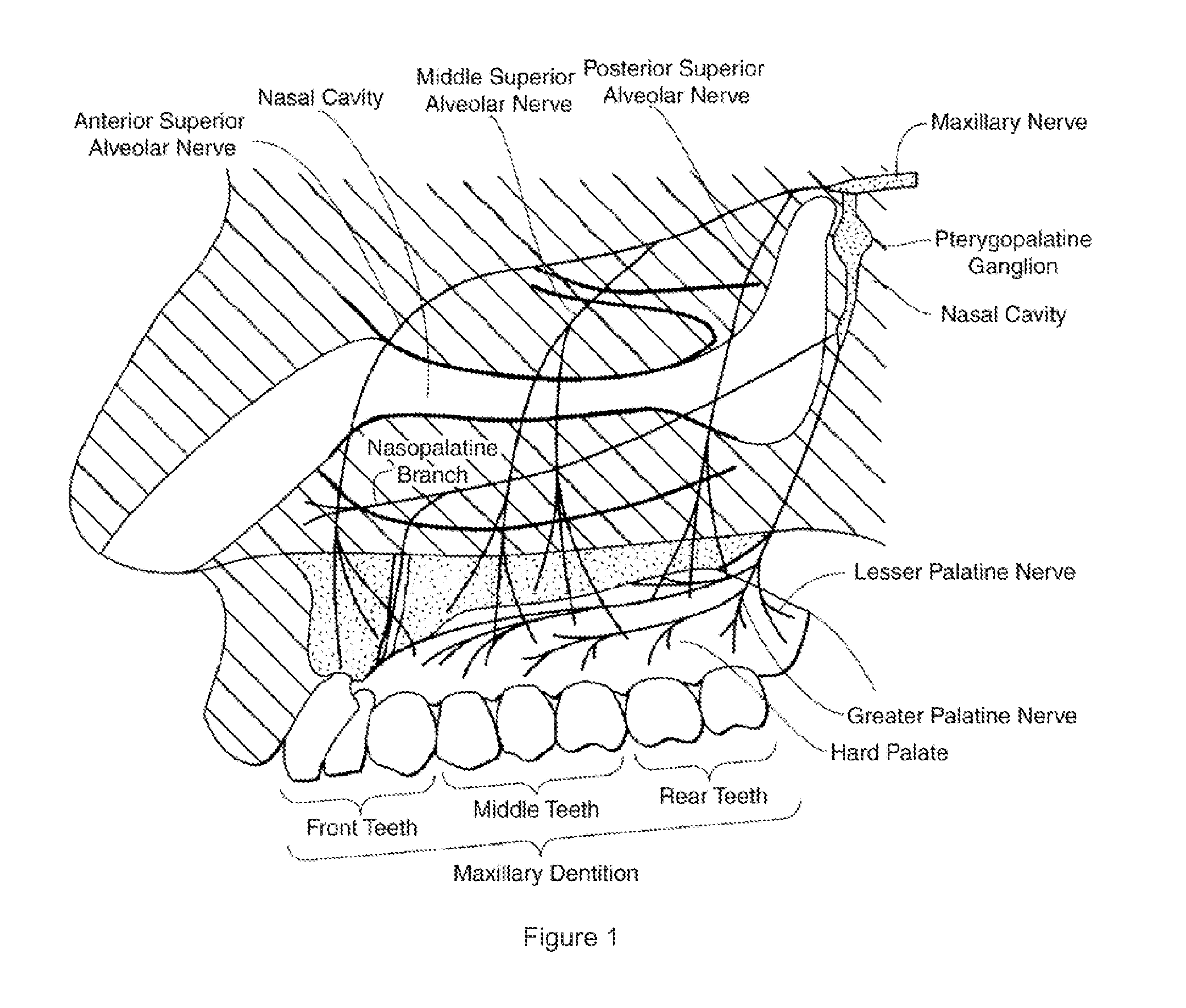 Dental anesthetic comprising tetracaine and a vasoconstrictor for intranasal administration