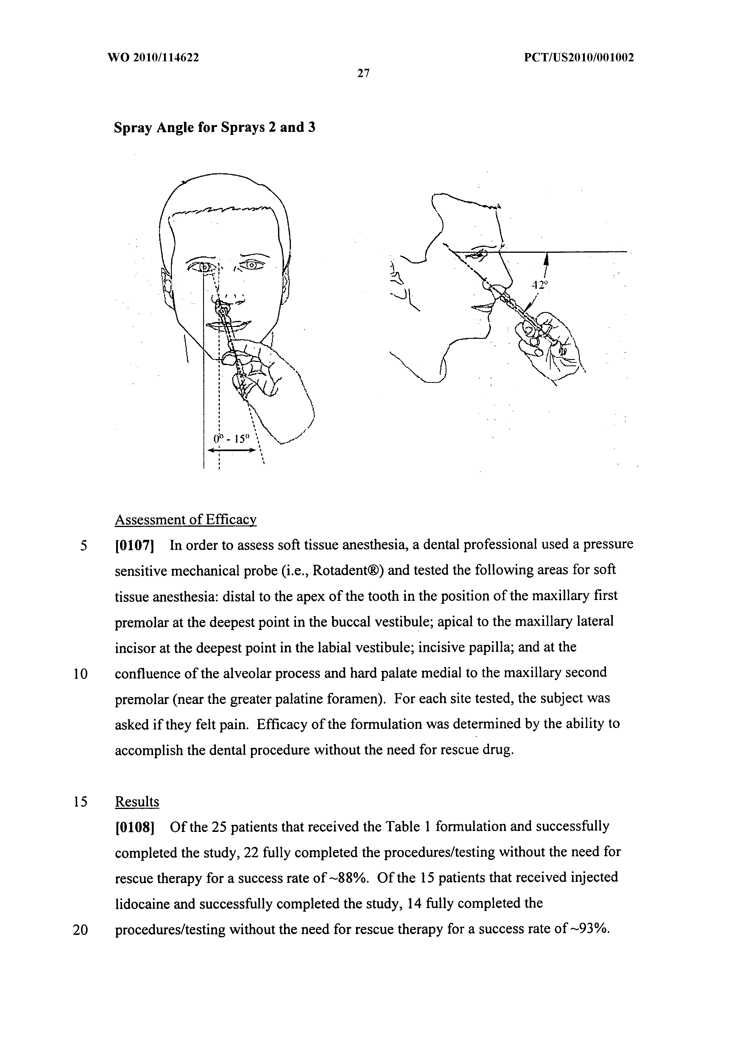 Dental anesthetic comprising tetracaine and a vasoconstrictor for intranasal administration