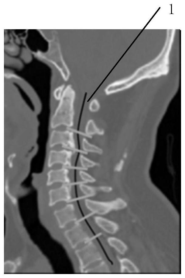 Spinal dura mater sac compression detection method and device and storage medium