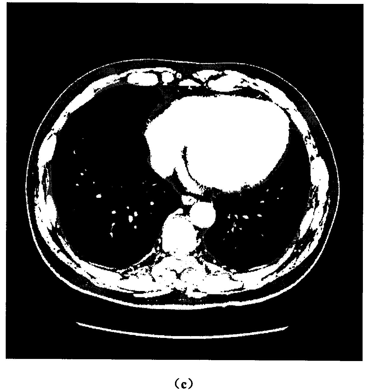 Medical image segmentation method based on quantum-behaved particle swarm cooperative optimization