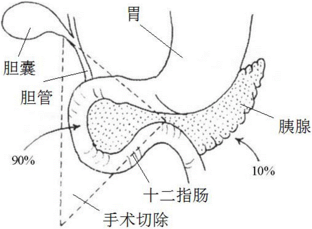 Digestive tract connector for reconstructing digestive tract in duodenectomy