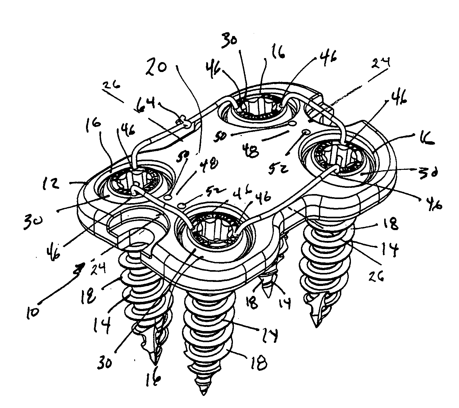 Anterior vertebral plate with suture lock