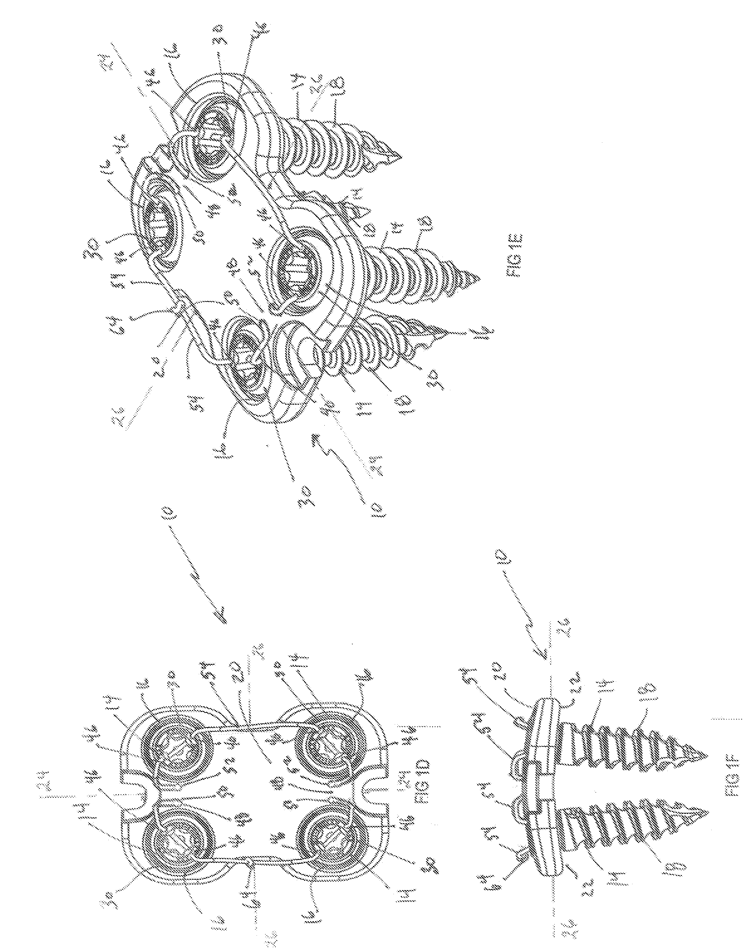 Anterior vertebral plate with suture lock