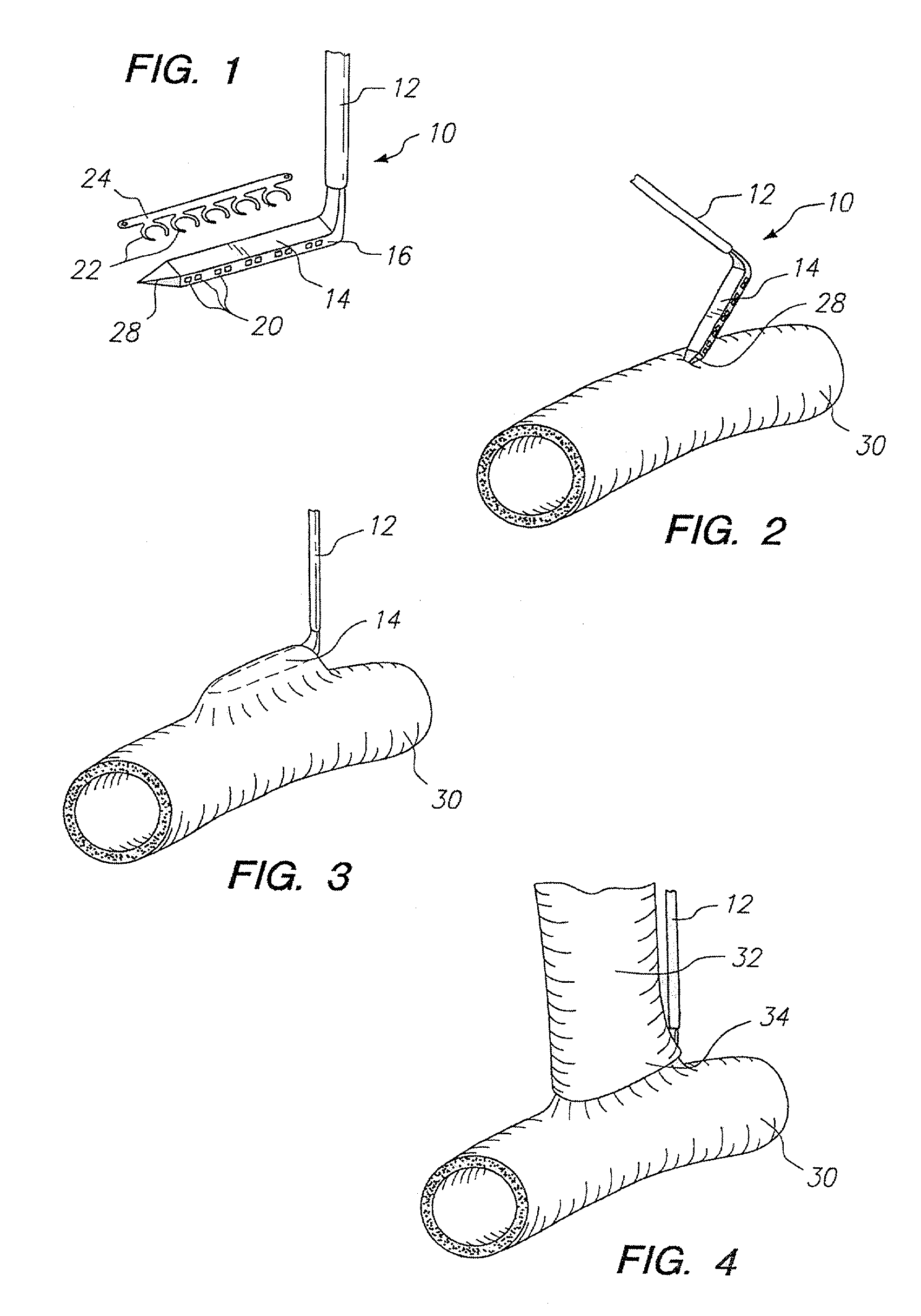 System for performing anastomosis