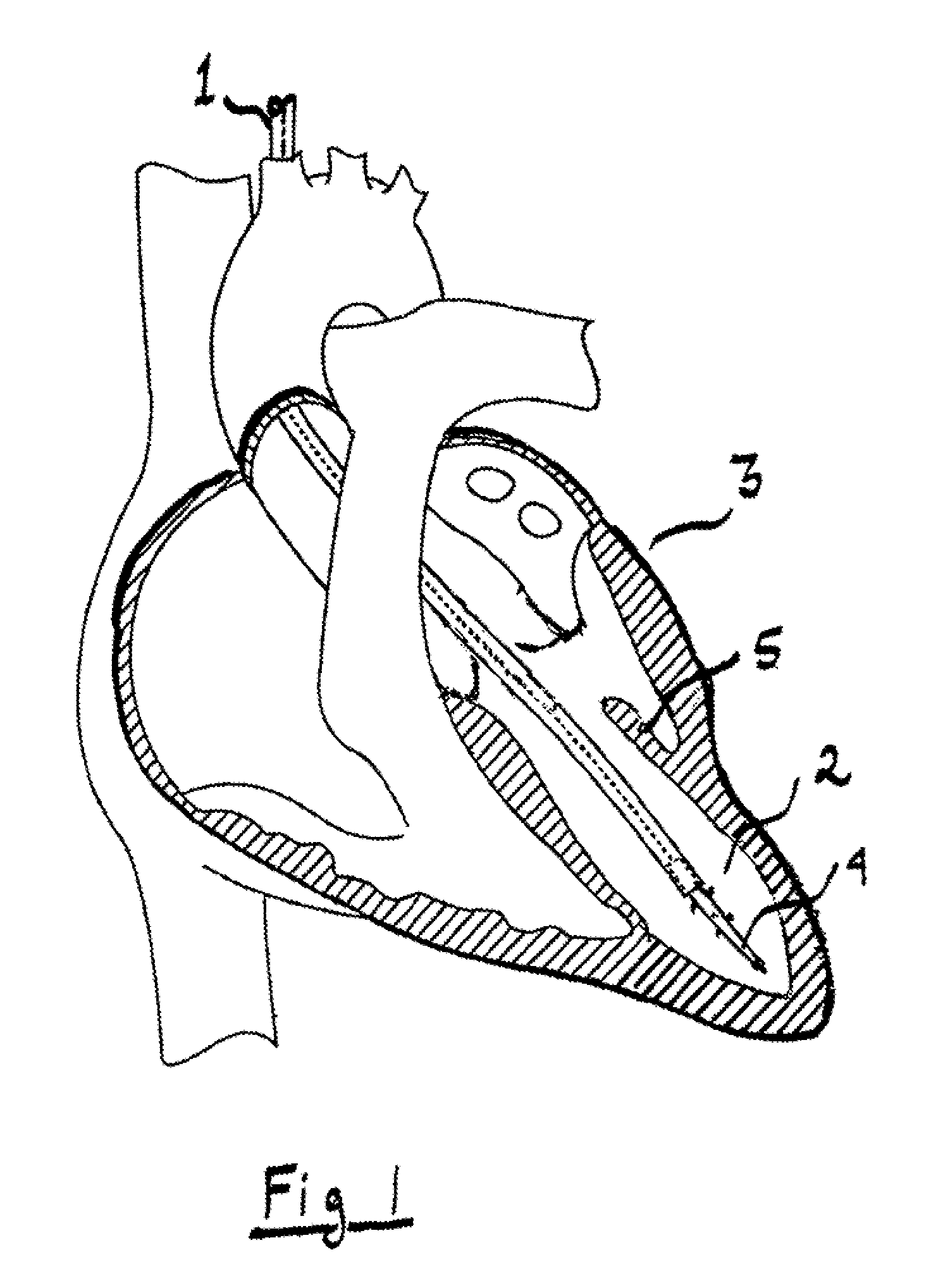 System for improving diastolic dysfunction