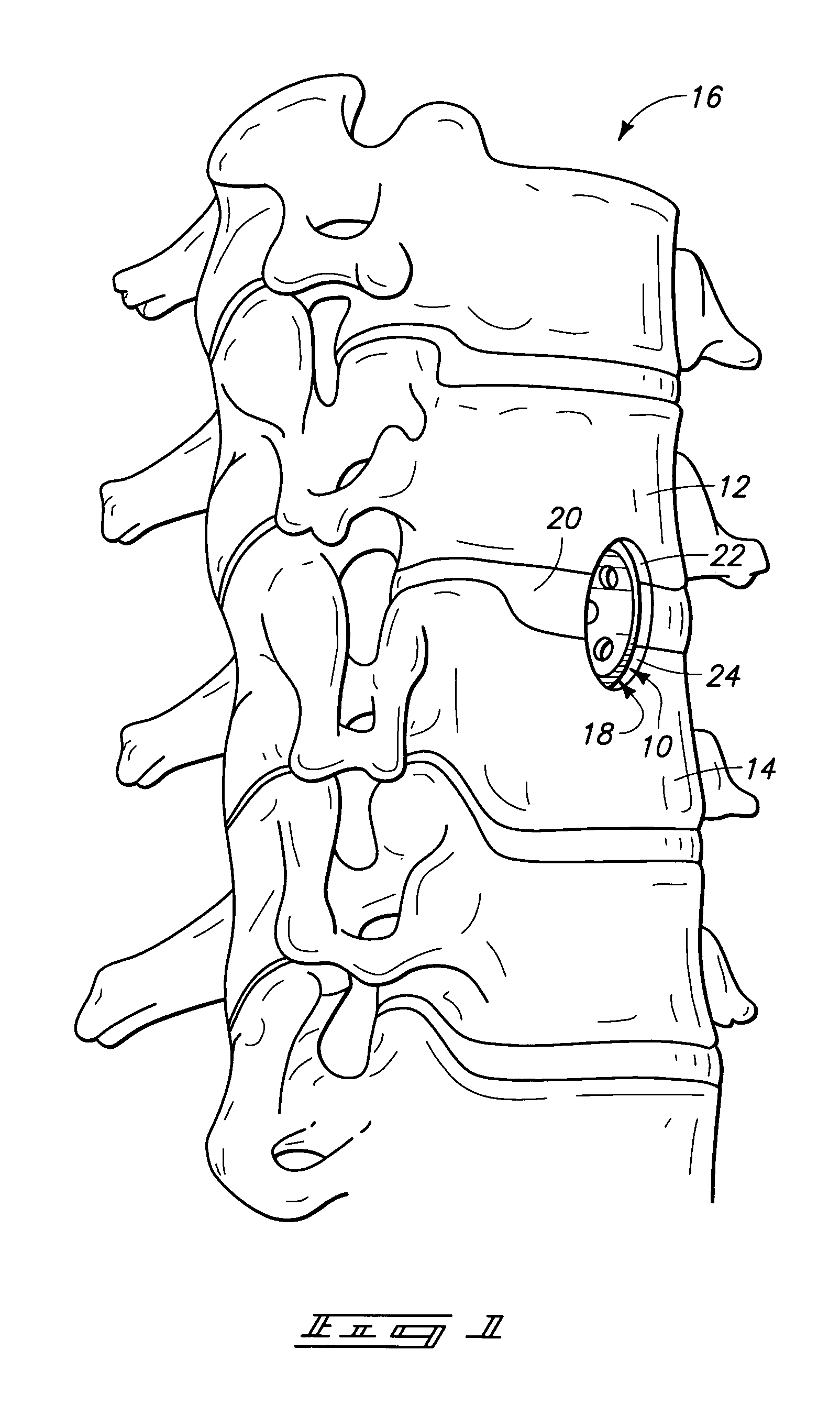 Apparatus and method for preparing a spinal implant surgical site for receiving a spinal fusion implant