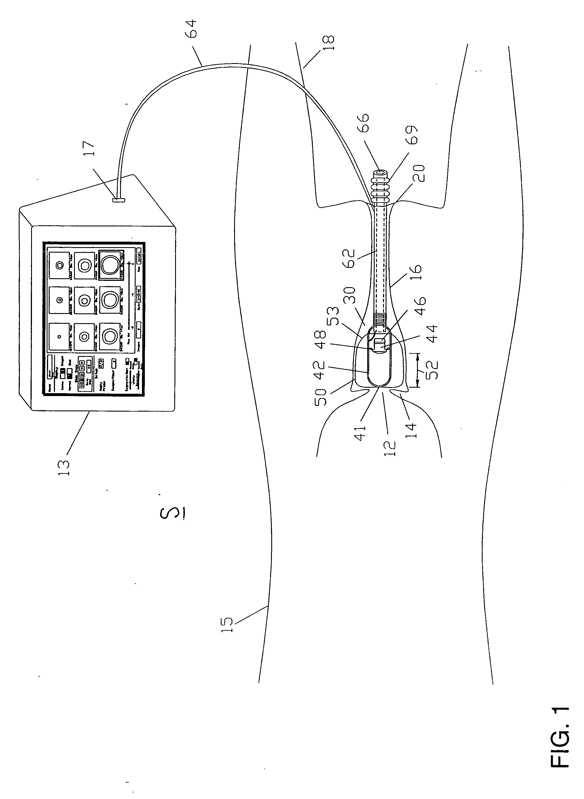 Cervix monitoring system and related devices and methods