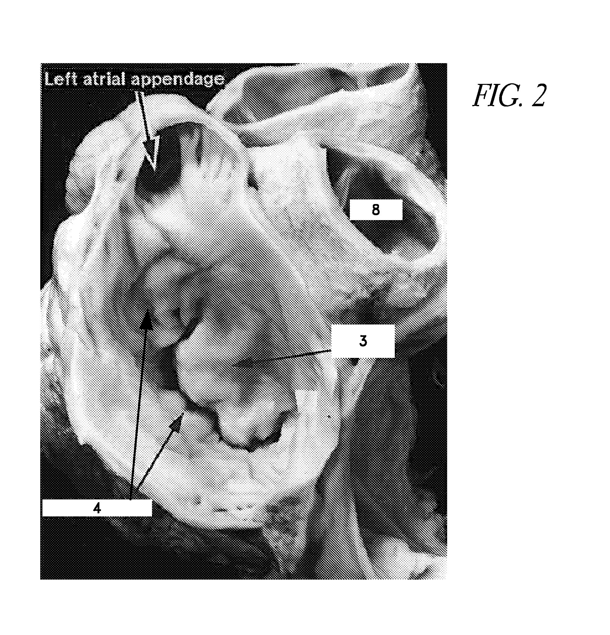 Method and apparatus for percutaneous delivery and deployment of a cardiovascular prosthesis