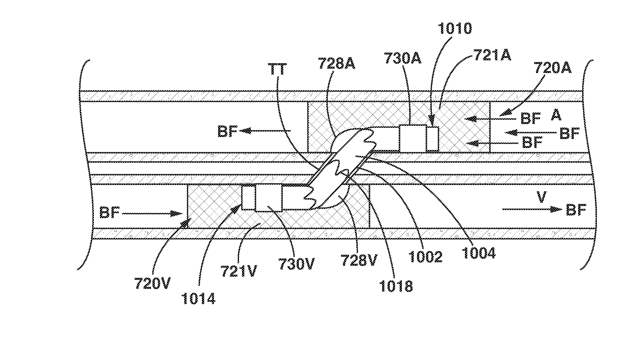 Arteriovenous Shunt Having Eccentric Anchor Stent