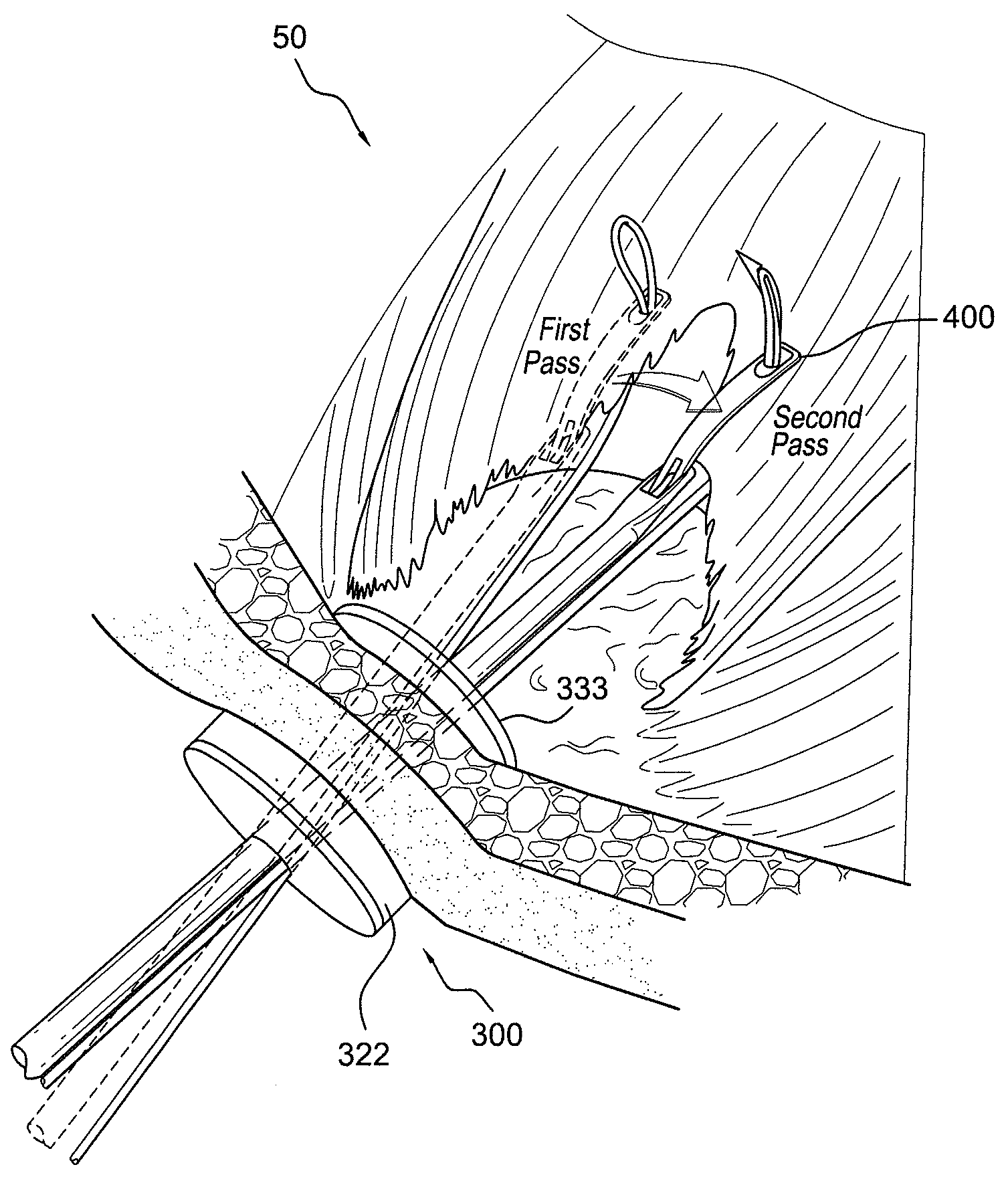 Button cannula